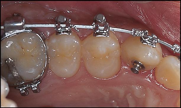 simultaneously by molar distalization without tooth extraction or the patient s cooperation. The treatment result was maintained well after 3 years of retention.