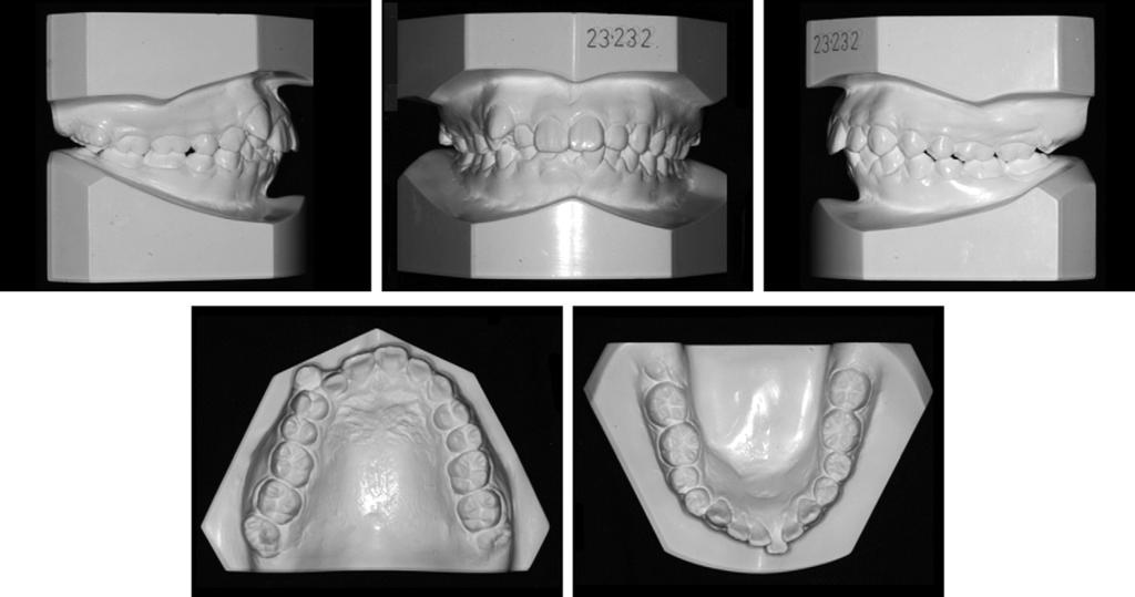 Choi et al 825 Fig 2. Pretreatment dental casts.