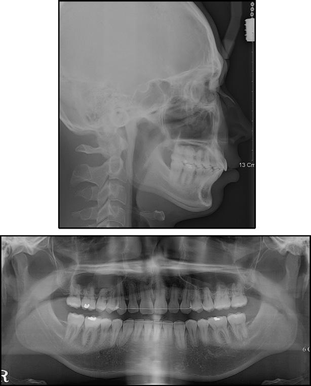 Lateral cephalogram and panoramic