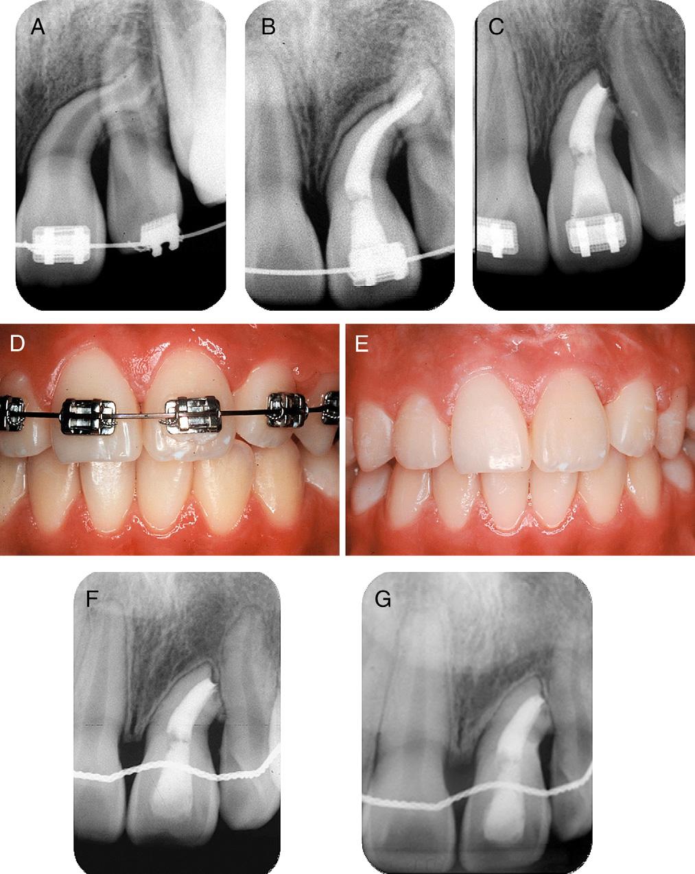 Figure 2. (A) Periapical radiograph of the root dilaceration; (B) after root canal filling; (C) and after apicoectomy.