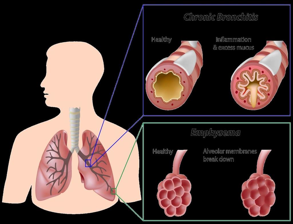Defining COPD Chronic Obstructive Pulmonary Disease (COPD) is now the preferred term for the conditions in patients with airflow limitation previously diagnosed as having chronic bronchitis and