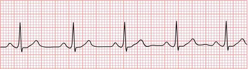 SINUS RHYTHM A sinus rhythm means the heart is following the instructions of the sinus node Indicators of Sinus Rhythm: 1. P before every QRS 2.