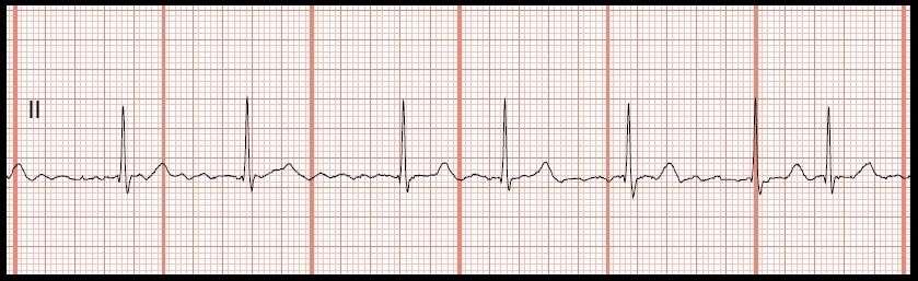 ATRIAL FIBRILATION (A-FIB) In A-fib, multiple areas of the atria are sending out impulses, causing irregular heart rate (hallmark of