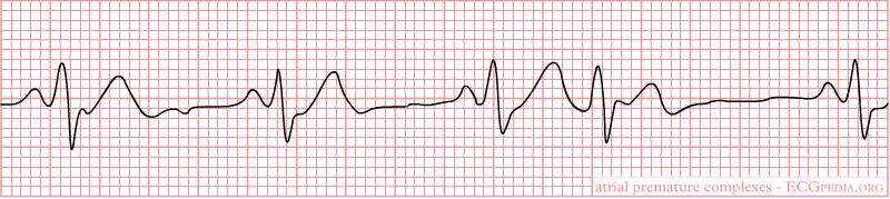 PREMATURE ATRIAL COMPLEX (PAC) A random, early QRS Same morphology (shape) as the other QRS complexes (indicates impulse traveled through AV node, so came from atria) Application