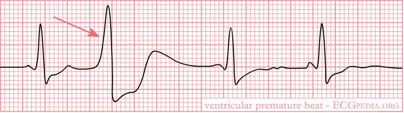PREMATURE VENTRICULAR COMPLEX (PVC) A random, early QRS Widened QRS and different morphology (indicates impulse originated below AV node) Application Frequent or runs of PVC s may warn of irritable