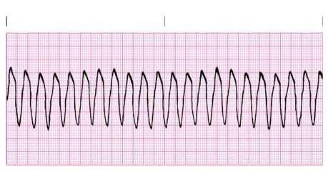 VENTRICULAR TACHYCARDIA (V-TACH) Life threatening! Call code blue and shock as soon as possible!