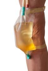 Securing your catheter A catheter securement device should be used to stop your catheter tube moving around.