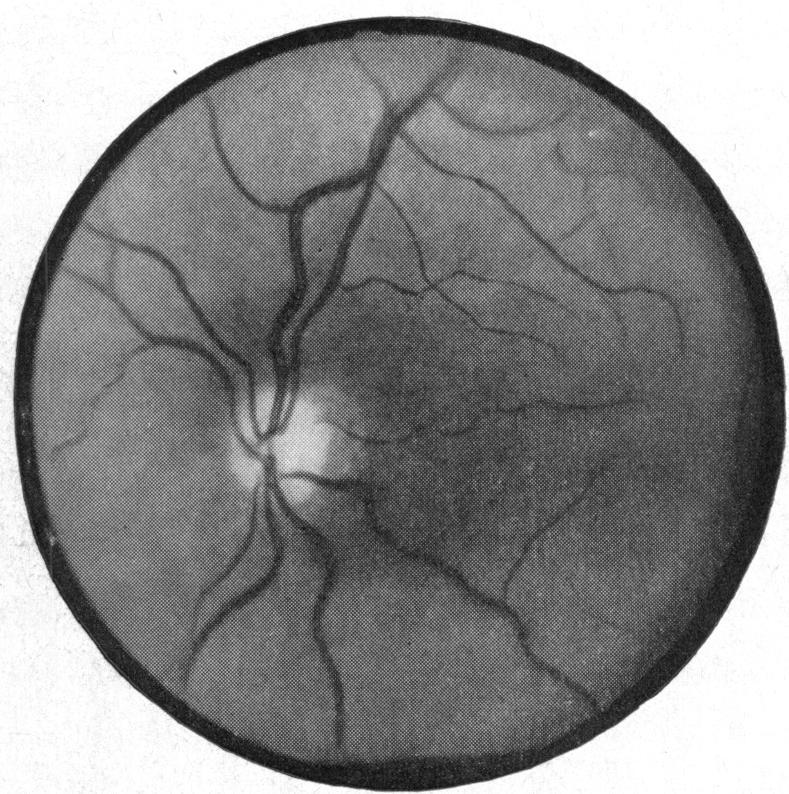 5252FROMA SOMERVILLE Right FIG. 1. Right optic disc.