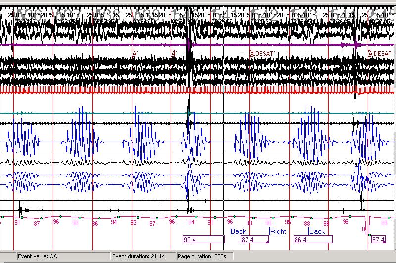 Central Sleep Apnea LOC ROC Chin EMG EEG EKG