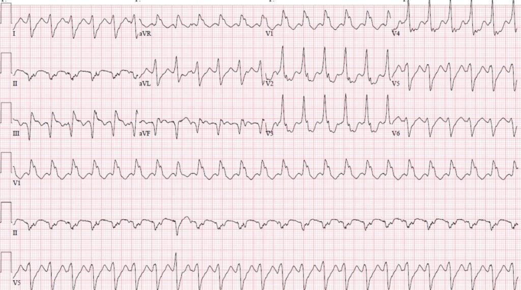 PRACTICE CASES Case 1 A 65-year-old man with a recent MI presents to the ED complaining of palpitations. He is cognitively intact without lightheadedness and has palpable pulses.