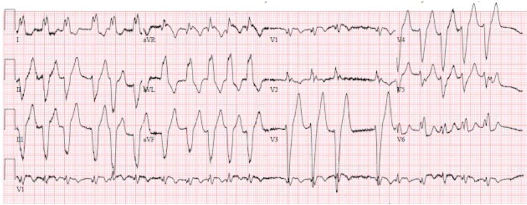 Case 3 A 60-year-old woman presents to the ED with fever, cough, and shortness of breath found to have the following ECG. She is tachycardic but has a normal blood pressure and cognitively intact.