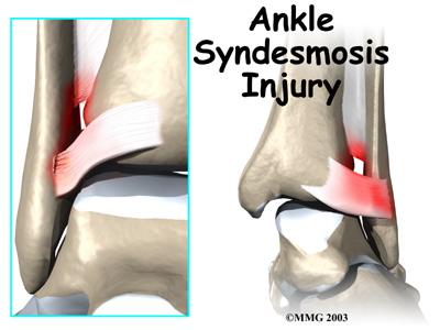 Introduction An ankle injury common to athletes is the ankle syndesmosis injury. This type of injury is sometimes called a high ankle sprain because it involves the ligaments above the ankle joint.