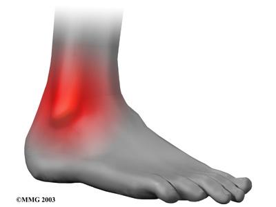 tears of the ankle syndesmosis may lead to ankle joint instability, which make the ankle mortise loose. In severe tears of the ligaments, the ends of the tibia and fibula actually spread apart.