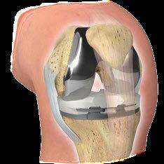 Understanding treatments for knee pain 11 What is total knee replacement A total knee replacement is typically considered when the surfaces on both sides of the bones are significantly damaged.