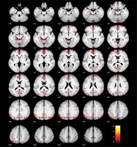 2 Overall brain gray matter density decline during 3 years in patients with major depression.