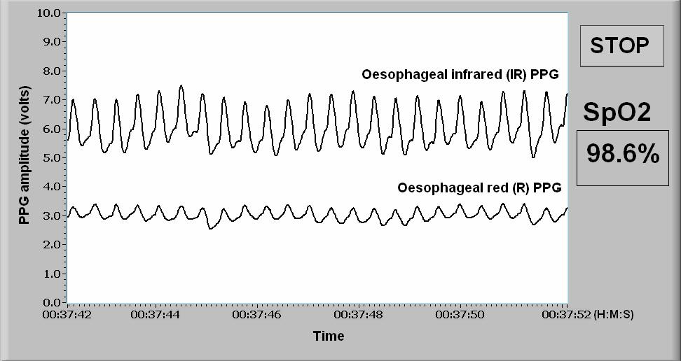 Linear Regression analysis was used to compare the blood oxygen saturation results from the oesophageal pulse oximeter with those from CO-oximetry.