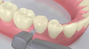As with all composite systems, Variolink Esthetic is subject to oxygen inhibition.