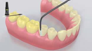 8 The teeth are fluoridated A thin film of Fluor Protector is applied with a Vivabrush or