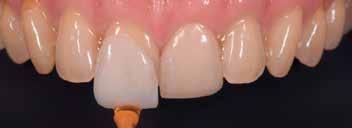 Celtra Duo (ZLS) thus behaves like a natural tooth enamel.
