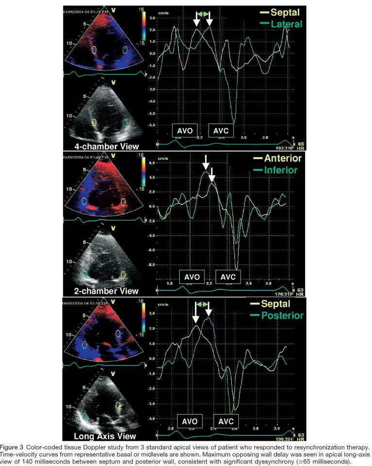 Echocardiography for cardiac resynchronization therapy: recommendations for performance and reporting a report from the American Society of