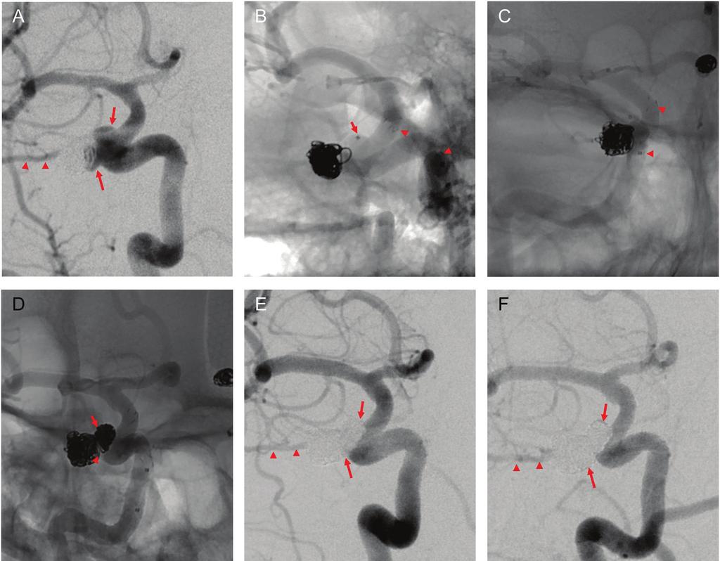 Wada T, et al. Fig. 1 A 42-year-old woman had KA of the right internal carotid artery-opha and recurrence after coiling of C3.