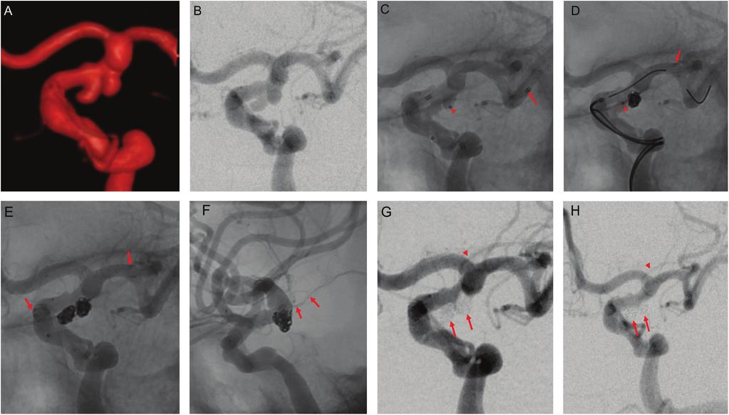 Single-stage Coil Embolization for Kissing Aneurysms Fig. 2 A 70-year-old man with KA of the left internal carotid artery.