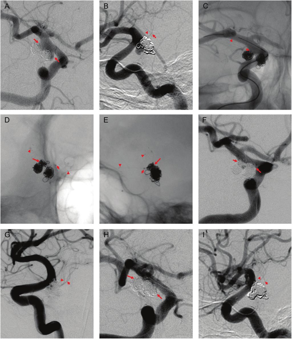 Wada T, et al. Fig. 3 A 55-year-old woman had KA recurrence after coiling of the right PCoA and AChA.