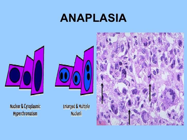 B. Characteristics of Cancer cells (How are they different from normal cells?) 1. Structure (Anaplasia) a.