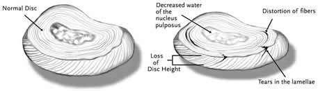 It makes up about 40 percent of the disc. This ball-like gel is contained within the lamellae. The nucleus is composed primarily of loose collagen fibers, water, and proteins.