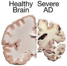 Degenerative Brain Disorders Alzheimer s