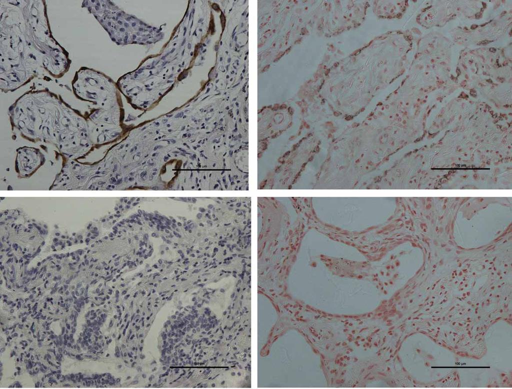 a) b) c) d) FIGURE 1 Immunohistochemical staining in paraffin-embedded, formalin-fixed surgical lung biopsies from 43 fibrotic interstitial lung disease patients.