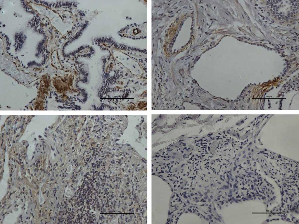 a) b) c) d) FIGURE 2 Immunohistochemical staining in paraffin-embedded, formalin-fixed surgical lung biopsies from 43 fibrotic interstitial lung disease patients.
