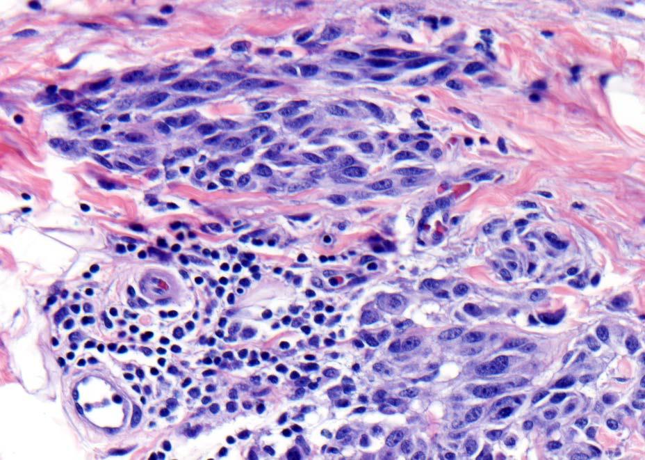 The tumor cells are discontinuous from the primary tumor and separated from the primary lesion by