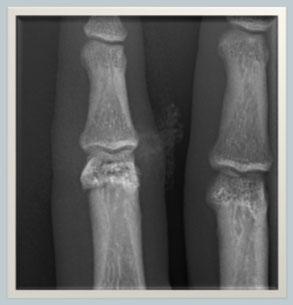 Post-injury Radiographs Surgical Procedure Closed reduction,