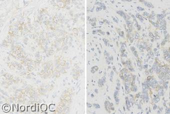 3 with a a HER-2/Chr. 7 ratio of.3.6. > 0 % of the neoplastic cells show a weak to moderate complete membranous staining corresponding to 2+.