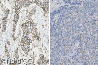 > 0 % of the neoplastic cells show a moderate complete membranous staining corresponding to 2+. Right: Optimal staining for HER-2 of the breast ductal carcinoma no. 2 with a HER-2/Chr. 7 ratio of.2.4.