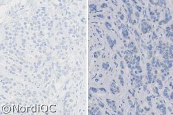 membranous staining corresponding to 3+. Right: Insufficient staining for HER-2 of the breast ductal carcinoma no. 4 with a HER-2/Chr. 7 ratio of 2.5 2.9.