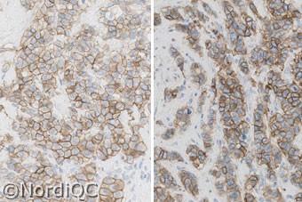 Also compare the results in Figs. 3b left and right. Fig. 3b Left: Insufficient staining for HER-2 of the breast ductal carcinoma no. 3 with a HER-2/Chr.7 ratio of.3.6.