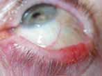 eyebrow follicles Sebaceous cell carcinoma is more common in the periocular area than