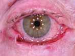 lesion is removed and narrow margins of surrounding tissues are