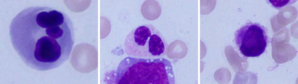 A B C Figure 1. Bone marrow smear specimen showing the presence trilineage dysplasia. (a) multinucleated erythroblast, (b) pseudo-pelger-huët anomaly in neutrophil, (c) micromegakaryocyte. Figure 2.