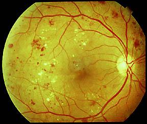 Systemic Complications of Diabetes 1. Retinopathy Visual impairment up to and including blindness from retinopathy, glaucoma, macula edema 2.