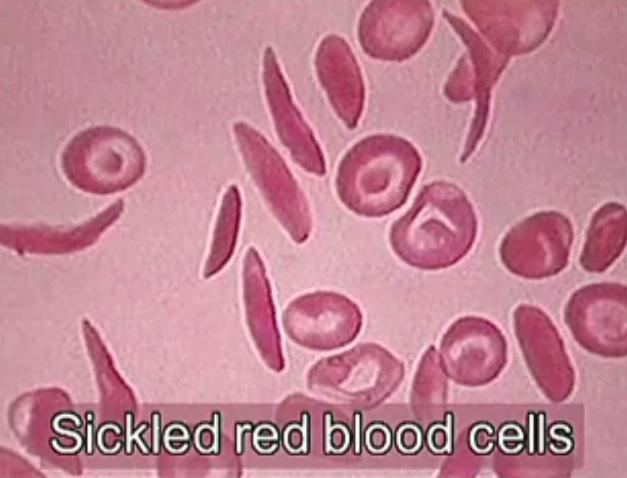 Sickle Cell Anemia Video Click here to view a video