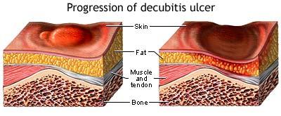 Staging Pressure Ulcers Stage I: A reddened area on the skin that, when pressed, is "non blanchable" (does not turn white). a pressure ulcer is starting to develop.