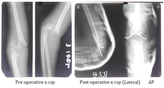 A displaced extension type supracondylar fracture of the humerus in a child may present problems in management including limb threatening, volkmann s ischaemia, neural palsy, cubitusvarus and