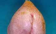 In penile urethral strictures due to: Failed hypospadias repair Lichen