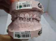 crowns (tooth 15,26,47) and 17 direct composites - 5 of
