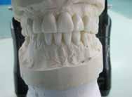2 x Penn Composite Stent (Penn Stent) for 8 upper teeth