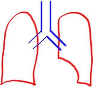 Causes: 1. Primary Pulmonary HTN 2.