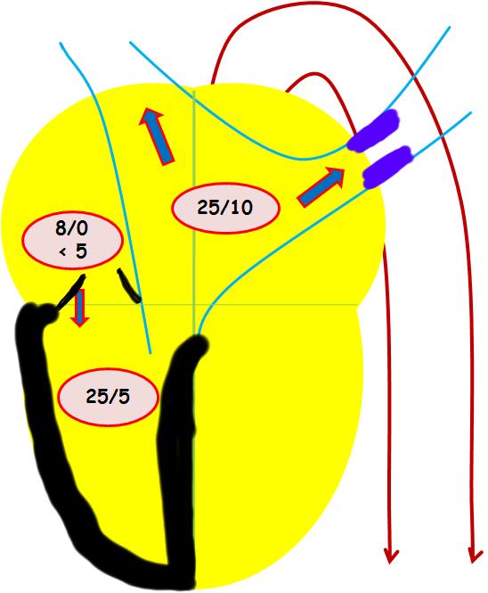 2/6 systolic murmur at LLSB TR >25 Pulmonary Artery